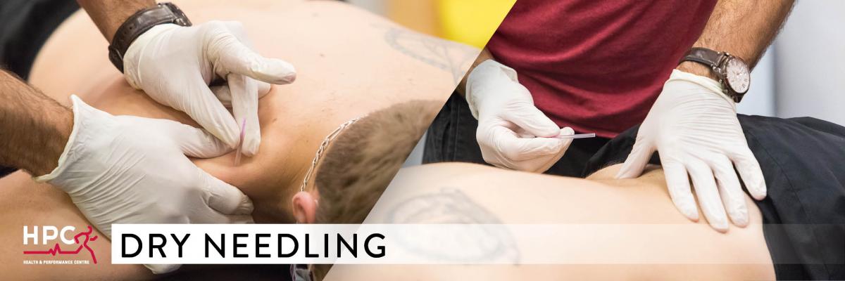 Dry Needling - HPC Physiotherapy Guelph