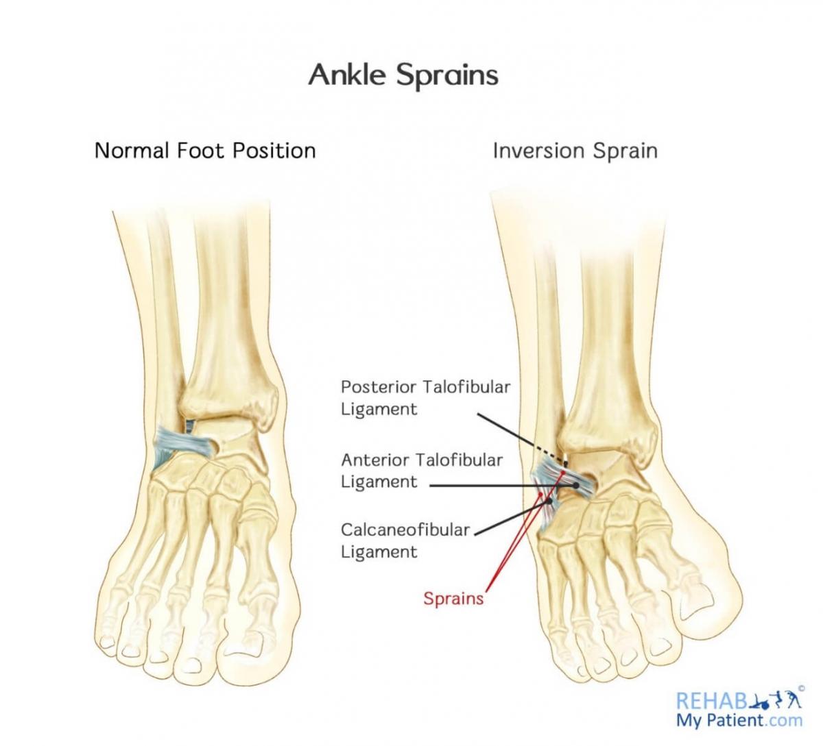 Diagram of ankle sprains