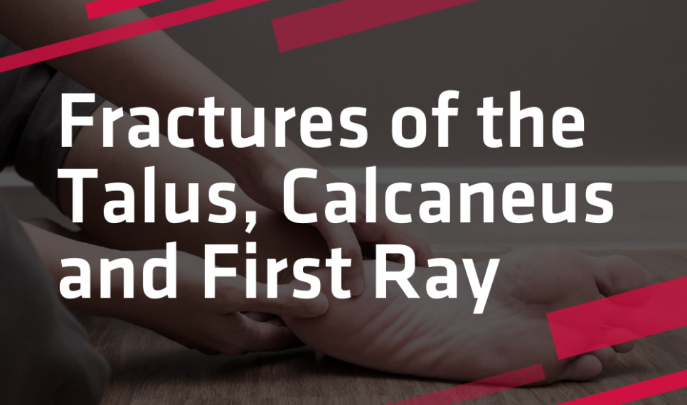 Fractures of the Talus, Guelph Physiotherapy