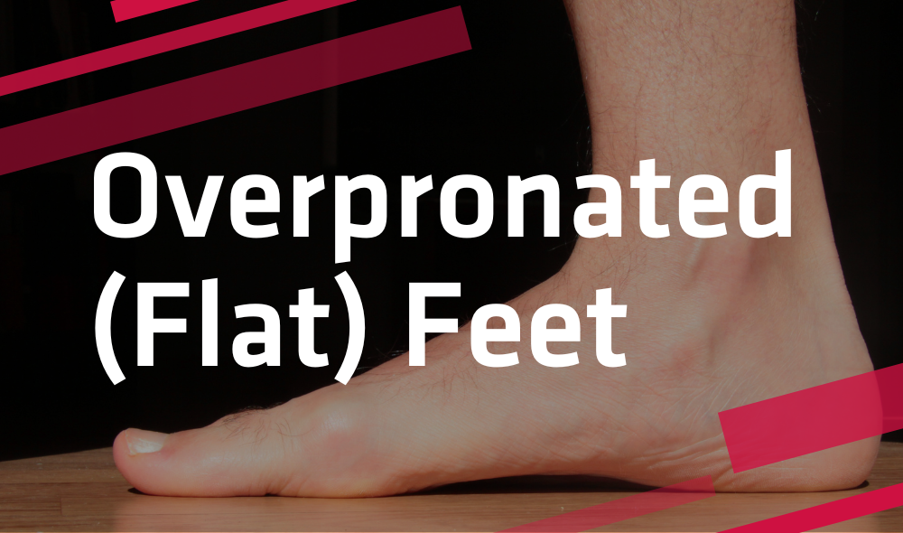 overpronated flat feet