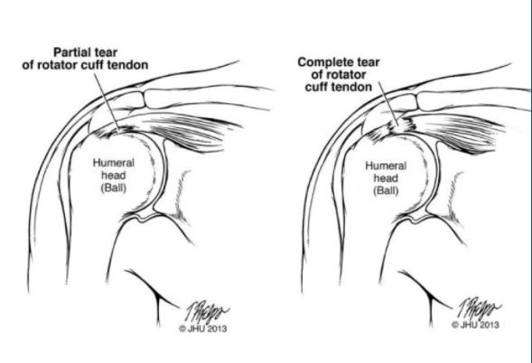 partial tear vs full tear of the rotator cuff