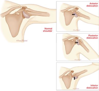 shoulder dislocation graphic